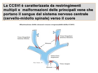 La CCSVI è caratterizzata da restringimenti
multipli e malformazioni delle principali vene che
portano il sangue dal sistema nervoso centrale
(cervello-midollo spinale) verso il cuore
 