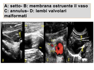 A: setto- B: membrana ostruente il vaso
C: annulus- D: lembi valvolari
malformati
 