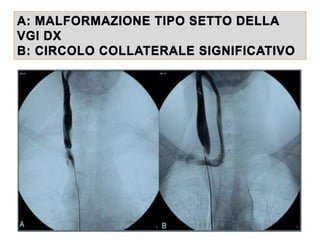 A: MALFORMAZIONE TIPO SETTO DELLA
VGI DX
B: CIRCOLO COLLATERALE SIGNIFICATIVO
 