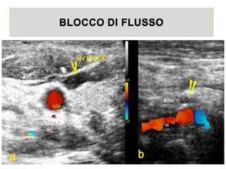 BLOCCO DI FLUSSO
 