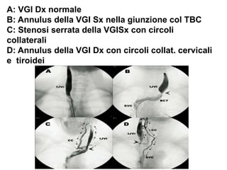 A: VGI Dx normale
B: Annulus della VGI Sx nella giunzione col TBC
C: Stenosi serrata della VGISx con circoli
collaterali
D: Annulus della VGI Dx con circoli collat. cervicali
e tiroidei
 