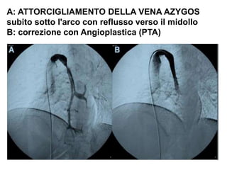 A: ATTORCIGLIAMENTO DELLA VENA AZYGOS
subito sotto l'arco con reflusso verso il midollo
B: correzione con Angioplastica (PTA)
 