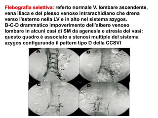 Flebografia selettiva: referto normale V. lombare ascendente,
vena iliaca e del plesso venoso intrarachidiano che drena
verso l'esterno nella LV e in alto nel sistema azygos.
B-C-D drammatico impoverimento dell'albero venoso
lombare in alcuni casi di SM da agenesia e atresia dei vasi:
questo quadro è associato a stenosi multiple del sistema
azygos configurando il pattern tipo D della CCSVI
 