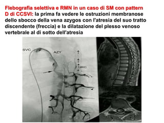Flebografia selettiva e RMN in un caso di SM con pattern
D di CCSVI: la prima fa vedere le ostruzioni membranose
dello sbocco della vena azygos con l'atresia del suo tratto
discendente (freccia) e la dilatazione del plesso venoso
vertebrale al di sotto dell'atresia
 