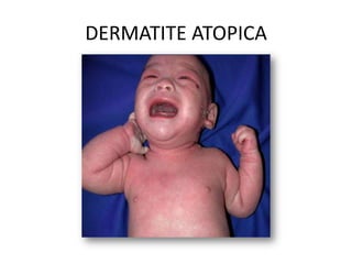 DERMATITE ATOPICA
 