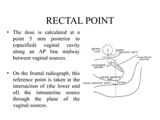 RECTAL POINT
• The dose is calculated at a
point 5 mm posterior to
(opacified) vaginal cavity
along an AP line midway
between vaginal sources.
• On the frontal radiograph, this
reference point is taken at the
intersection of (the lower end
of) the intrauterine source
through the plane of the
vaginal sources.
 