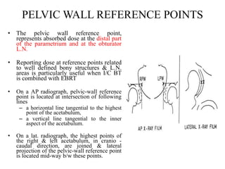 PELVIC WALL REFERENCE POINTS
• The pelvic wall reference point,
represents absorbed dose at the distal part
of the parametrium and at the obturator
L.N.
• Reporting dose at reference points related
to well defined bony structures & L.N.
areas is particularly useful when I/C BT
is combined with EBRT
• On a AP radiograph, pelvic-wall reference
point is located at intersection of following
lines
– a horizontal line tangential to the highest
point of the acetabulum,
– a vertical line tangential to the inner
aspect of the acetabulum.
• On a lat. radiograph, the highest points of
the right & left acetabulum, in cranio -
caudal direction, are joined & lateral
projection of the pelvic-wall reference point
is located mid-way b/w these points.
 