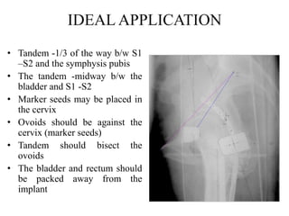 IDEAL APPLICATION
• Tandem -1/3 of the way b/w S1
–S2 and the symphysis pubis
• The tandem -midway b/w the
bladder and S1 -S2
• Marker seeds may be placed in
the cervix
• Ovoids should be against the
cervix (marker seeds)
• Tandem should bisect the
ovoids
• The bladder and rectum should
be packed away from the
implant
 