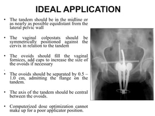 IDEAL APPLICATION
• The tandem should be in the midline or
as nearly as possible equidistant from the
lateral pelvic wall
• The vaginal colpostats should be
symmetrically positioned against the
cervix in relation to the tandem
• The ovoids should fill the vaginal
fornices, add caps to increase the size of
the ovoids if necessary
.
• The ovoids should be separated by 0.5 –
1.0 cm, admitting the flange on the
tandem.
• The axis of the tandem should be central
between the ovoids.
• Computerized dose optimization cannot
make up for a poor applicator position.
 