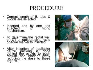 PROCEDURE
• Correct length of IU-tube &
ovoids are selected
• Inserted one by one and
attached to fixing
mechanism.
• To determine the rectal wall
on CT or radiograph a radio
opaque marker is inserted
• After insertion of applicator
gauze packing is done
behind the ovoids to push
rectum and bladder away
reducing the dose to these
organs
 