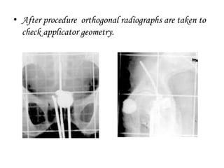 • After procedure orthogonal radiographs are taken to
check applicator geometry.
 