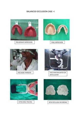 BALANCED OCCLUSION CASE –I

PRELIMINARY IMPRESSION

FACE-BOW TRANSFER

EXTRA ORAL TRACING

FINAL IMPRESSION

FACE-BOW MOUNTED ON
ARTICULATOR

INTER OCCLUSAL RECORDING

 