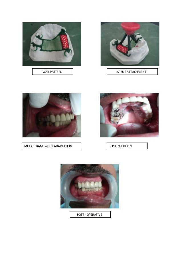 Conventional complete denture /certified fixed orthodontic courses b…