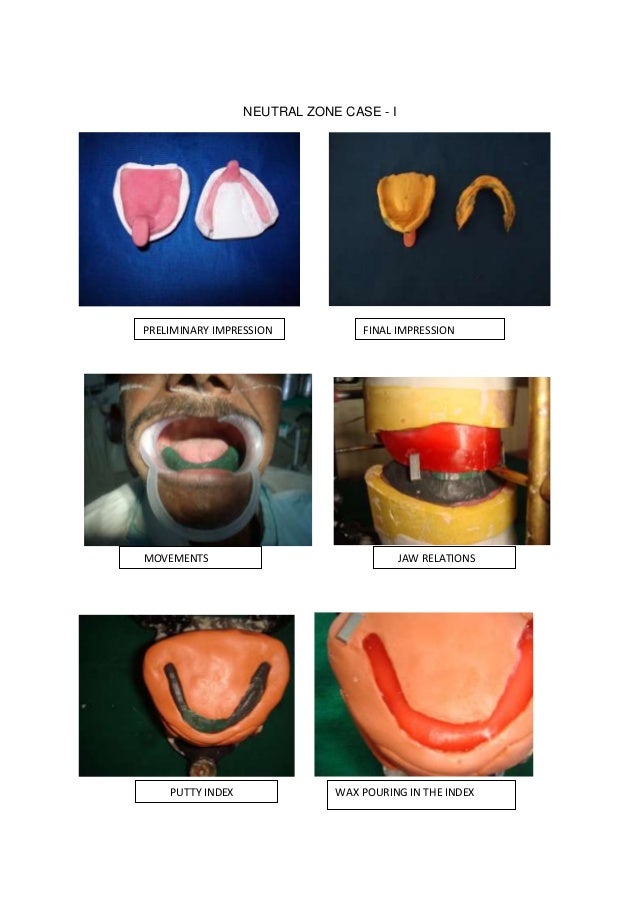 Conventional complete denture/cosmetic dentistry course by Indian den…