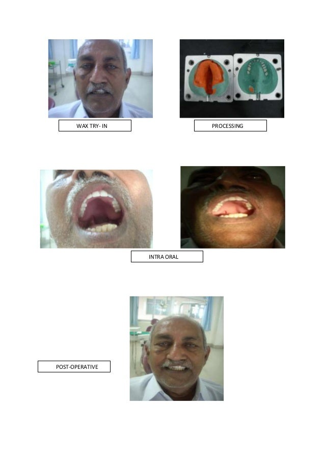Conventional complete denture/cosmetic dentistry course by Indian den…