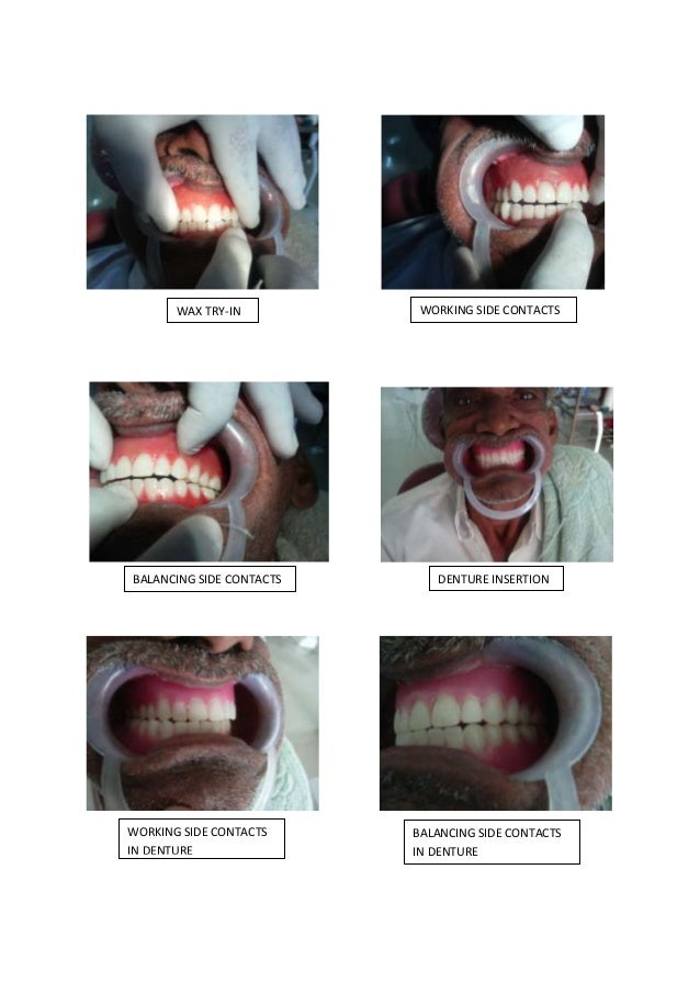Conventional complete denture/cosmetic dentistry course by Indian den…