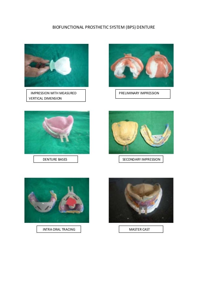 Conventional complete denture/cosmetic dentistry course by Indian den…