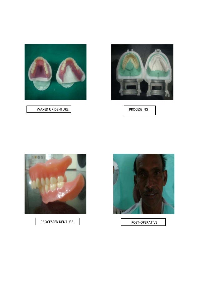 Conventional complete denture/cosmetic dentistry course by Indian den…