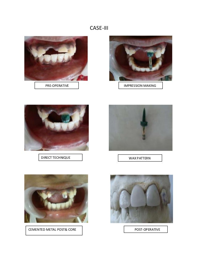 Conventional complete denture/cosmetic dentistry course by Indian den…