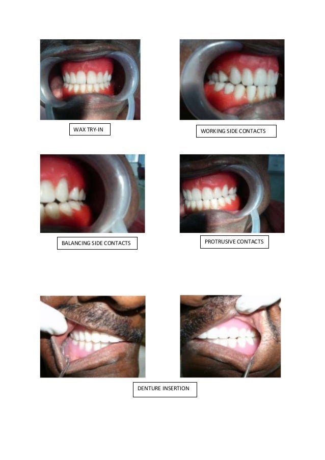 Conventional complete denture/cosmetic dentistry course by Indian den…