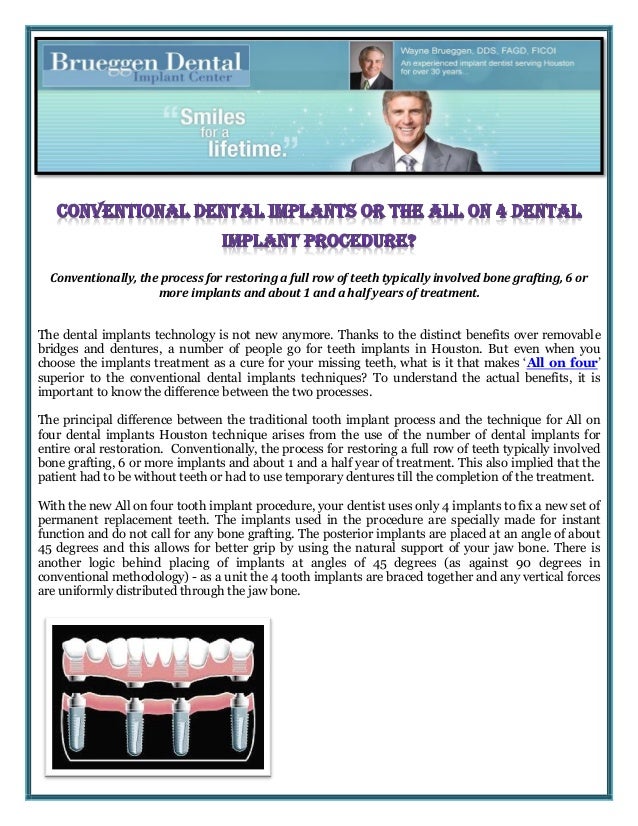 Conventional Dental Implants or the All on 4 Dental Implant Procedure?
