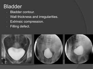 Bladder Compression Guide Conventional imaging of ut by dr.abd alla shady md | PPTX