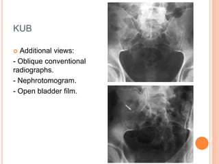 KUB
 Additional views:
- Oblique conventional
radiographs.
- Nephrotomogram.
- Open bladder film.
 