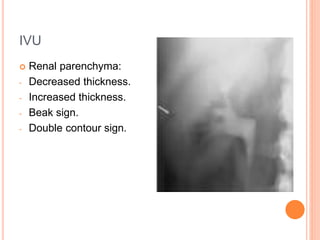 IVU
 Renal parenchyma:
- Decreased thickness.
- Increased thickness.
- Beak sign.
- Double contour sign.
 