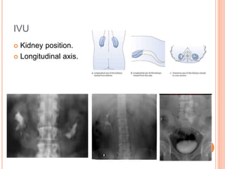IVU
 Kidney position.
 Longitudinal axis.
 