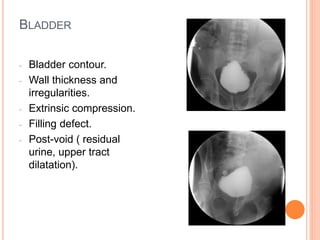 BLADDER
- Bladder contour.
- Wall thickness and
irregularities.
- Extrinsic compression.
- Filling defect.
- Post-void ( residual
urine, upper tract
dilatation).
 