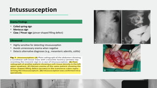 Spring Sign Intersusception Conventional Radiography in Pediatric Gastrointestinal Imaging An ...