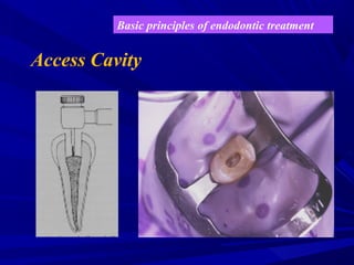 Fill Access Pot Rct Conventional RCT | PPT