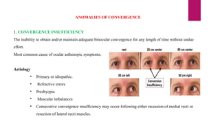 ANOMALIES OF CONVERGENCE
1. CONVERGENCE INSUFFICIENCY
The inability to obtain and/or maintain adequate binocular convergence for any length of time without undue
effort.
Most common cause of ocular asthenopic symptoms.
Aetiology
• Primary or idiopathic.
• Refractive errors
• Presbyopia
• Muscular imbalances
• Consecutive convergence insufficiency may occur following either recession of medial recti or
resection of lateral recti muscles.
 