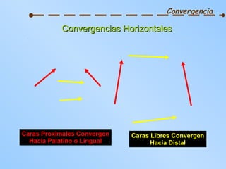 Convergencia Convergencias Horizontales Caras Libres Convergen Hacia Distal Caras Proximales Convergen Hacia Palatino o Lingual 