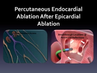 Percutaneous Endocardial
Ablation After Epicardial
Ablation
Percutaneous Access
Breakthrough Locations @
Pericardial Reflections
 
