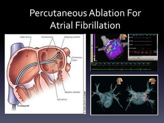 PercutaneousAblation For
Atrial Fibrillation
 