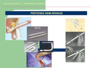 DISFUNÇÃO ERÉCTIL – TRATAMENTO CIRÚRGICO

PRÓTESES SEMI-RÍGIDAS

AMS 650

DURA II

ACCUFORM

 