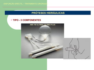 DISFUNÇÃO ERÉCTIL – TRATAMENTO CIRÚRGICO

PRÓTESES HIDRÁULICAS


TIPO - 3 COMPONENTES
AMS 700 ULTREX / ULTREX PLUS

 