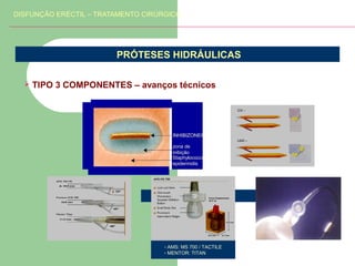 DISFUNÇÃO ERÉCTIL – TRATAMENTO CIRÚRGICO

PRÓTESES HIDRÁULICAS


TIPO 3 COMPONENTES – avanços técnicos

INHIBIZONE®
zona de
inibição
Staphylococcus
epidermidis

- AMS: MS 700 / TACTILE
- MENTOR: TITAN

 