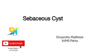 Sebaceous Cyst
 