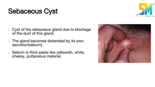 Sebaceous Cyst
• Cyst of the sebaceous gland due to blockage
of the duct of this gland.
• The gland becomes distended by its own
secretion(sebum).
• Sebum is thick paste like yellowish, white,
cheesy, pultaceous material.
 