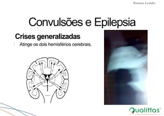 Convulsões e Epilepsia Prof. Me PostGrad Romano, Leandro
! Atinge os dois hemisférios cerebrais.
Convulsões e Epilepsia
Crises generalizadas
 
