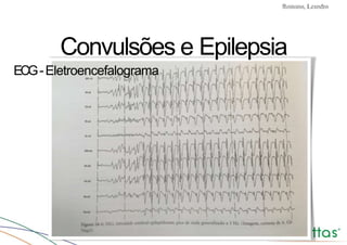 Convulsões e Epilepsia Prof. Me PostGrad Romano, Leandro
Convulsões e Epilepsia
ECG-Eletroencefalograma
 