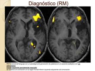 Diagnóstico (RM)

RM funcional del lenguaje con un paradigma de generación de palabras en un paciente epiléptico con un
astrocitoma
insular izquierdo parcialmente resecado.
Se observa una activación en la región frontal inferior izquierda adyacente a la tumoración.

 