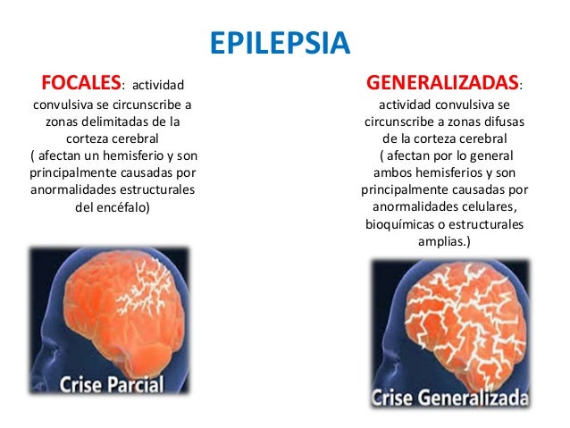 Resultado de imagen para epilepsia generalizada
