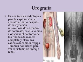 Urografia
• Es una técnica radiológica
para la exploración del
aparato urinario después
de la inyección
intravenosa de un medio
de contraste, en ella vamos
a observar el contorno de
los riñones de manera
completa y clara, los
cálices así como la vejiga.
También nos sirven para
ver el sistema de drenaje
renal.
 
