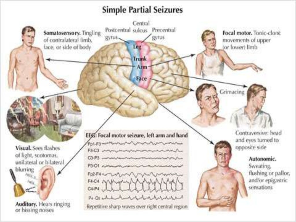 pediatric convulsion
