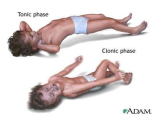 CONVULSIONS (SEIZURES).ppt