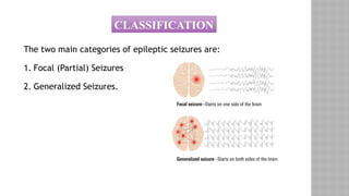 The two main categories of epileptic seizures are:
1. Focal (Partial) Seizures
2. Generalized Seizures.
CLASSIFICATION
 