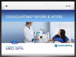 COOLSCULPTING® BEFORE & AFTERS
 